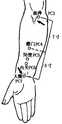 Ximen(PC4, the Cleft acupoint),Jianshi(PC5, the River acupoint)